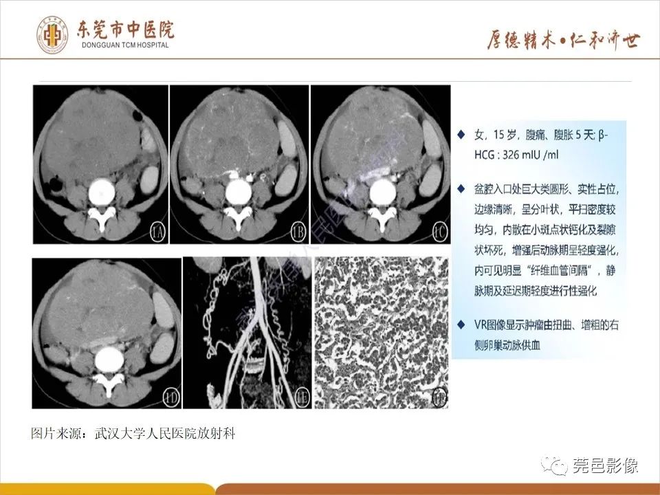 影像PPT - 【PPT】卵巢透明细胞癌CT/MRI诊断及鉴别诊断-30