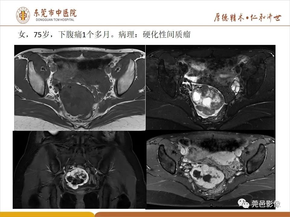 影像PPT - 【PPT】卵巢透明细胞癌CT/MRI诊断及鉴别诊断-33