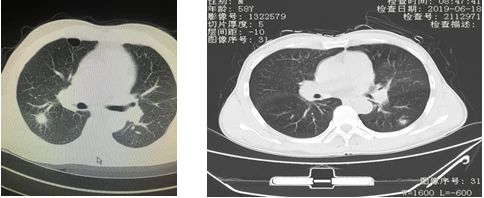 影像PPT - 肺结节的评估手段及全程管理-1 影像PPT - 肺结节的评估手段及全程管理-1