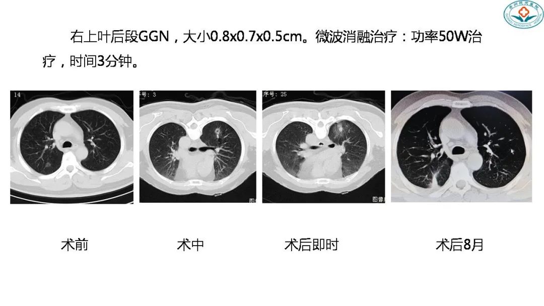 影像PPT - 肺结节的评估手段及全程管理-14 影像PPT - 肺结节的评估手段及全程管理-14