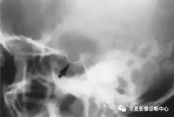 影像PPT - 垂体正常表现及垂体瘤影像诊断-3 影像PPT - 垂体正常表现及垂体瘤影像诊断-3