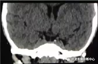 影像PPT - 垂体正常表现及垂体瘤影像诊断-4 影像PPT - 垂体正常表现及垂体瘤影像诊断-4