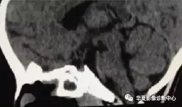 影像PPT - 垂体正常表现及垂体瘤影像诊断-5 影像PPT - 垂体正常表现及垂体瘤影像诊断-5