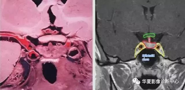 影像PPT - 垂体正常表现及垂体瘤影像诊断-6 影像PPT - 垂体正常表现及垂体瘤影像诊断-6