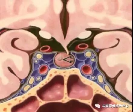 影像PPT - 垂体正常表现及垂体瘤影像诊断-9 影像PPT - 垂体正常表现及垂体瘤影像诊断-9