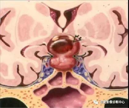 影像PPT - 垂体正常表现及垂体瘤影像诊断-10 影像PPT - 垂体正常表现及垂体瘤影像诊断-10