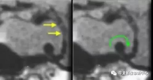 影像PPT - 垂体正常表现及垂体瘤影像诊断-12 影像PPT - 垂体正常表现及垂体瘤影像诊断-12