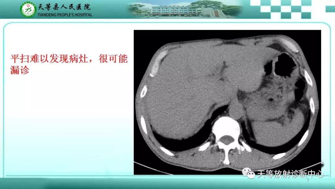 影像PPT - 【PPT】肝脏增强扫描的重要意义-5