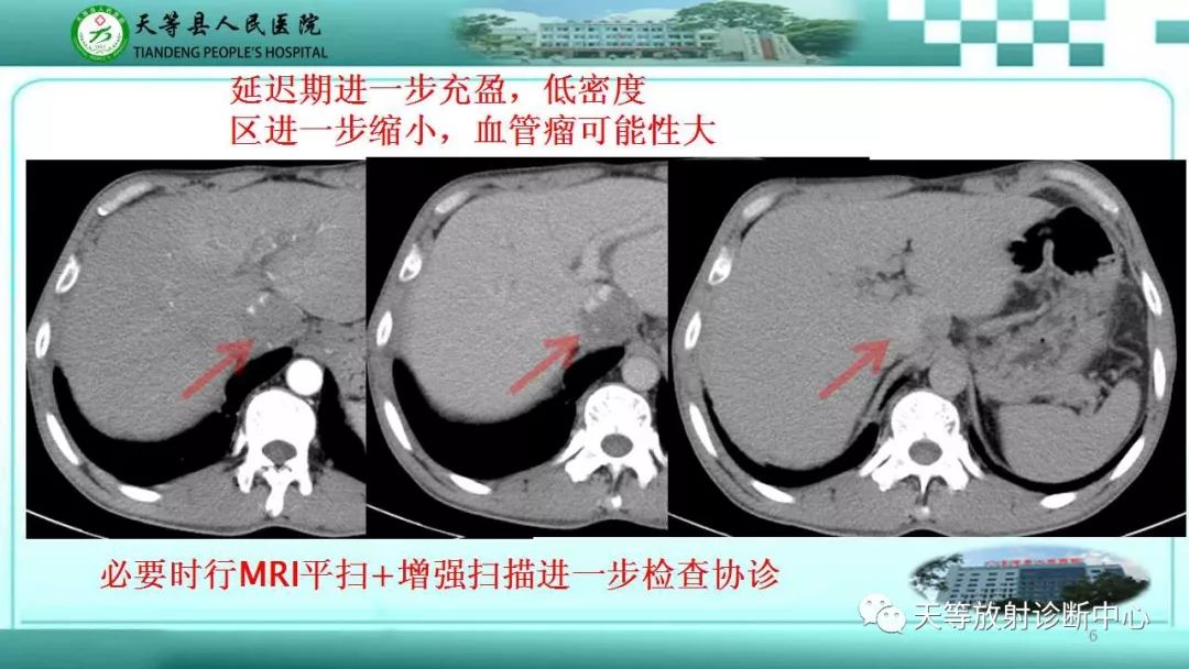 影像PPT - 【PPT】肝脏增强扫描的重要意义-6