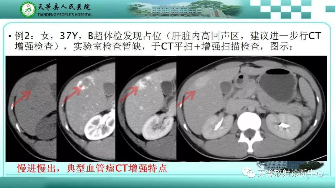 影像PPT - 【PPT】肝脏增强扫描的重要意义-7