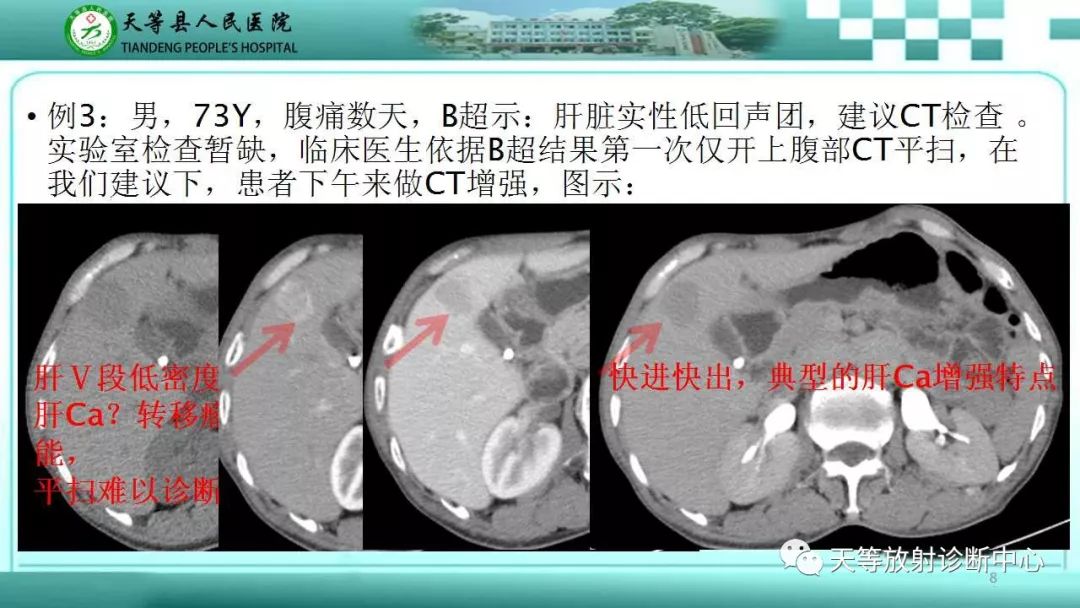 影像PPT - 【PPT】肝脏增强扫描的重要意义-8