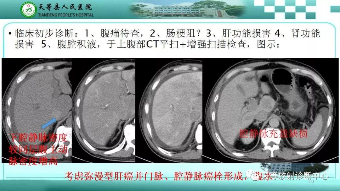 影像PPT - 【PPT】肝脏增强扫描的重要意义-10