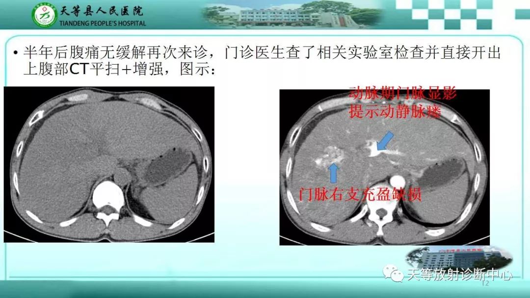 影像PPT - 【PPT】肝脏增强扫描的重要意义-12