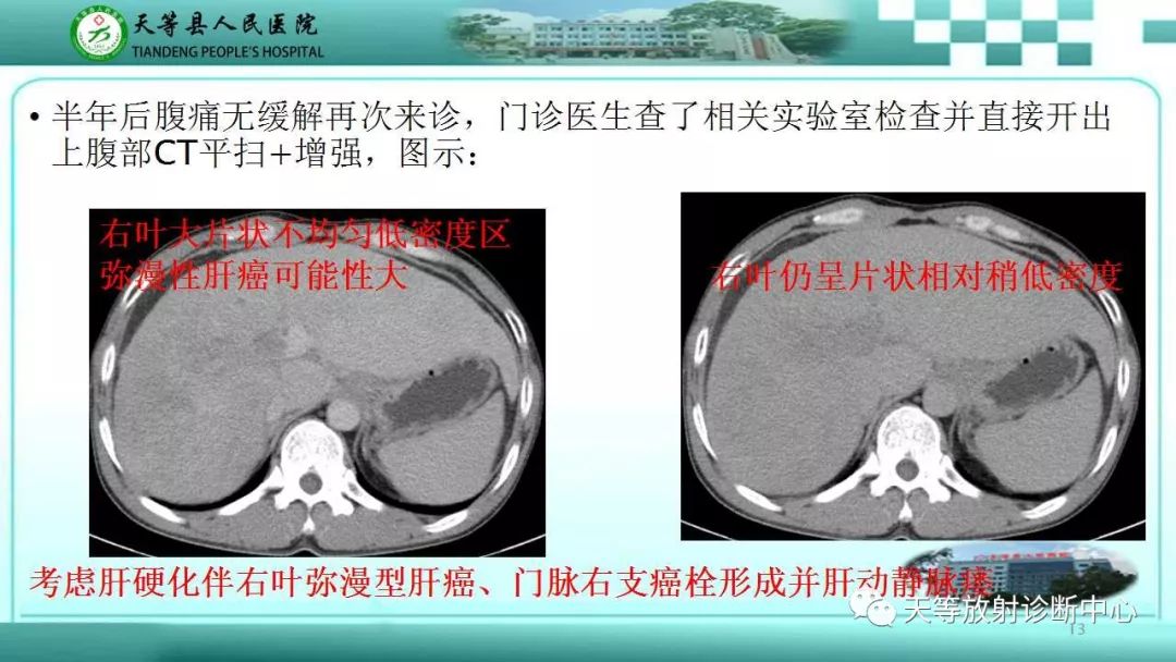 影像PPT - 【PPT】肝脏增强扫描的重要意义-13