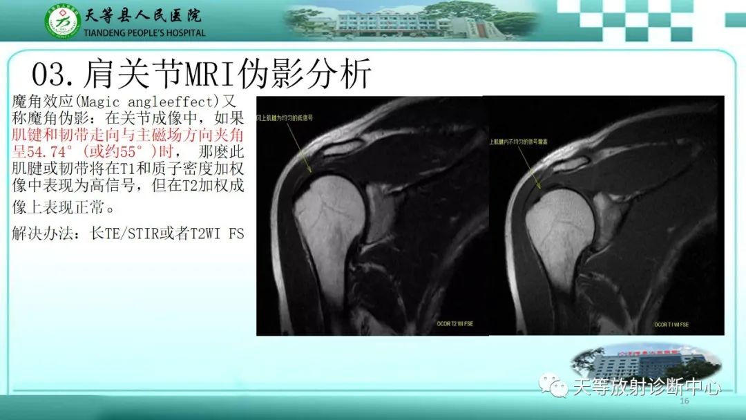 影像PPT - 【PPT】肩关节MRI扫描技术-16