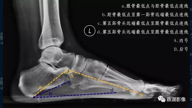 影像PPT - 扁平足X线测量方法-7 影像PPT - 扁平足X线测量方法-7