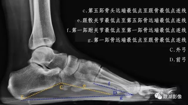 影像PPT - 扁平足X线测量方法-8 影像PPT - 扁平足X线测量方法-8