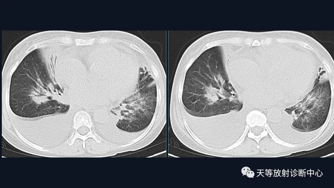 影像PPT - 【病例】ANCA相关性血管炎肺部改变-19
