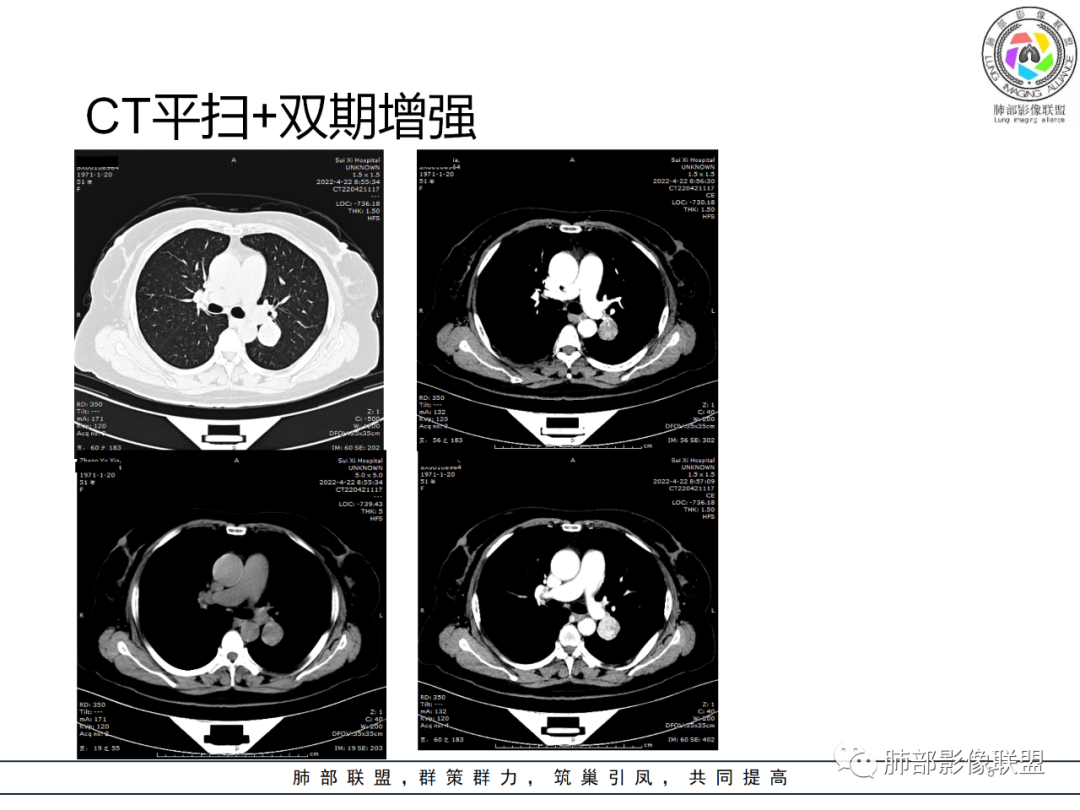 影像PPT - 【病例】硬化性肺泡细胞瘤PSP一例CT-5 影像PPT - 【病例】硬化性肺泡细胞瘤PSP一例CT-5