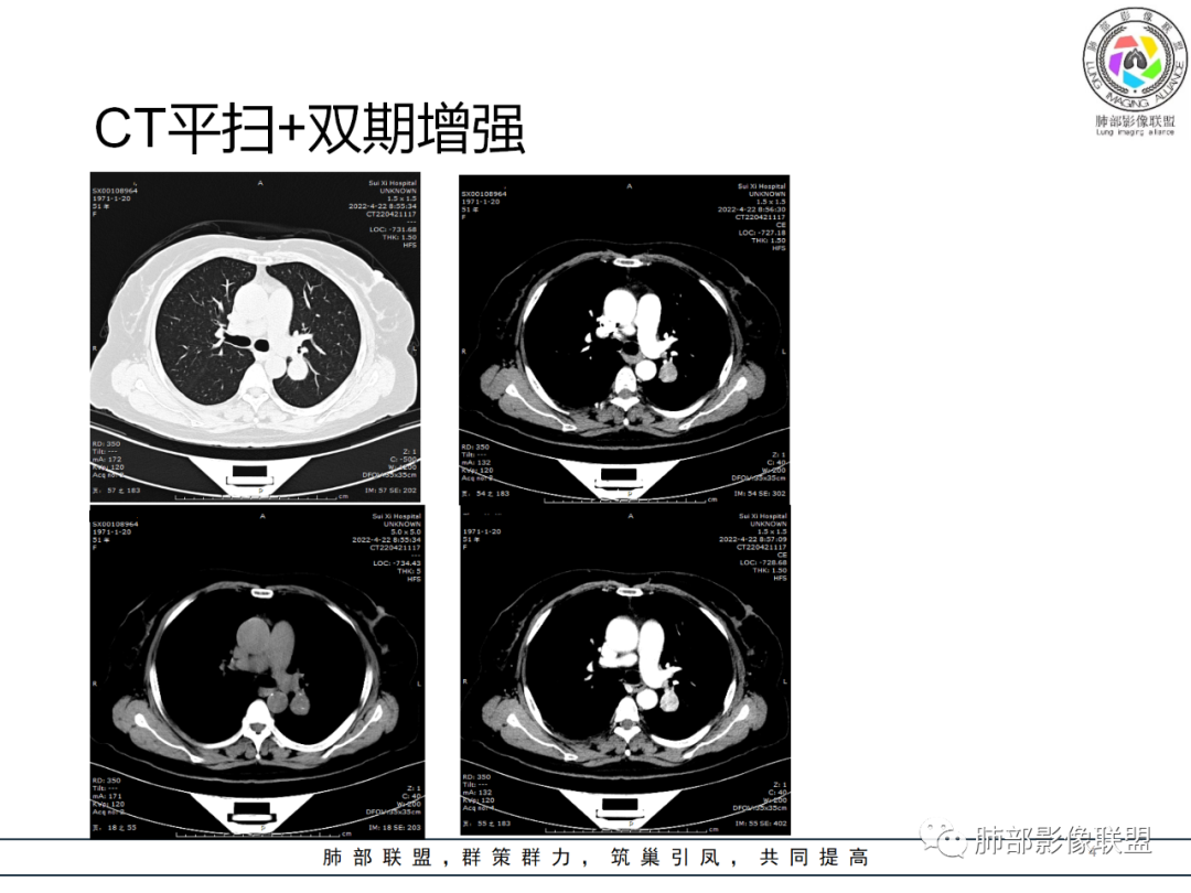 影像PPT - 【病例】硬化性肺泡细胞瘤PSP一例CT-4 影像PPT - 【病例】硬化性肺泡细胞瘤PSP一例CT-4