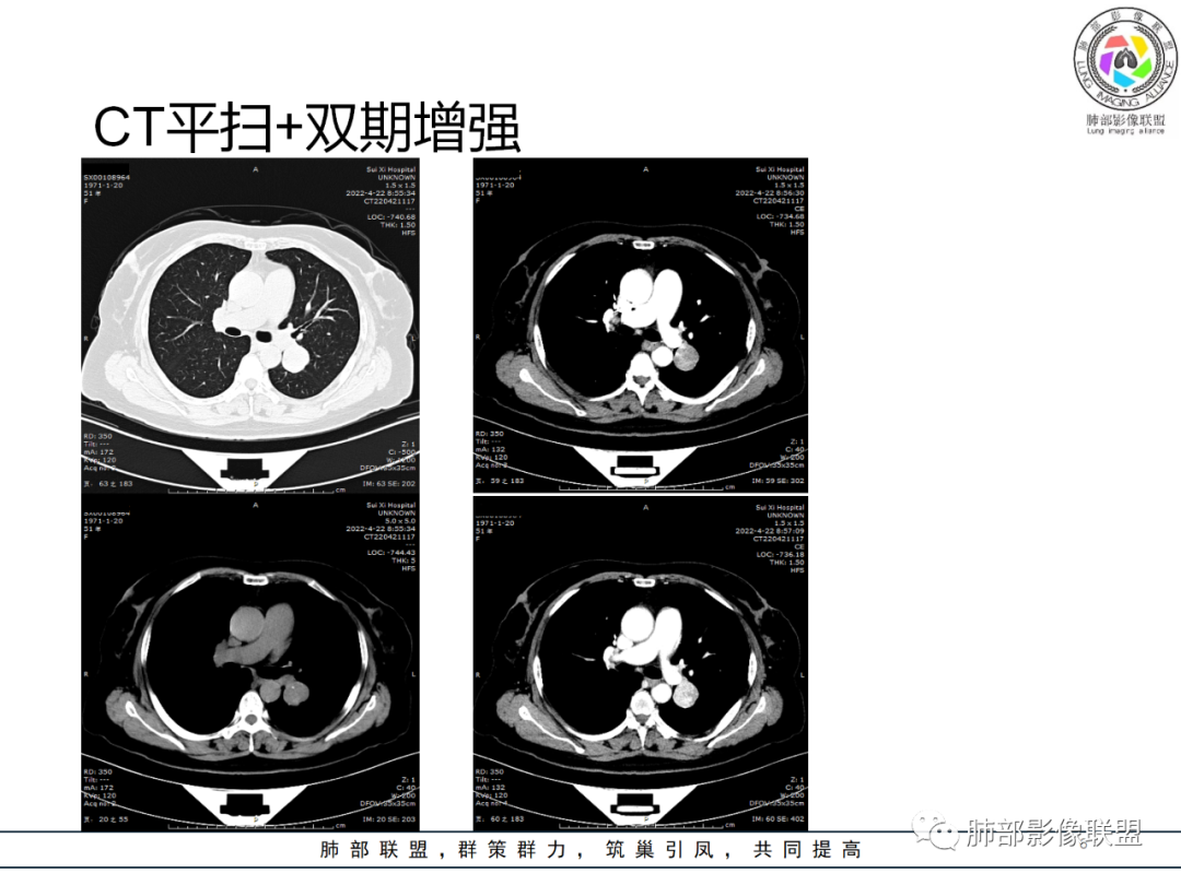 影像PPT - 【病例】硬化性肺泡细胞瘤PSP一例CT-6 影像PPT - 【病例】硬化性肺泡细胞瘤PSP一例CT-6