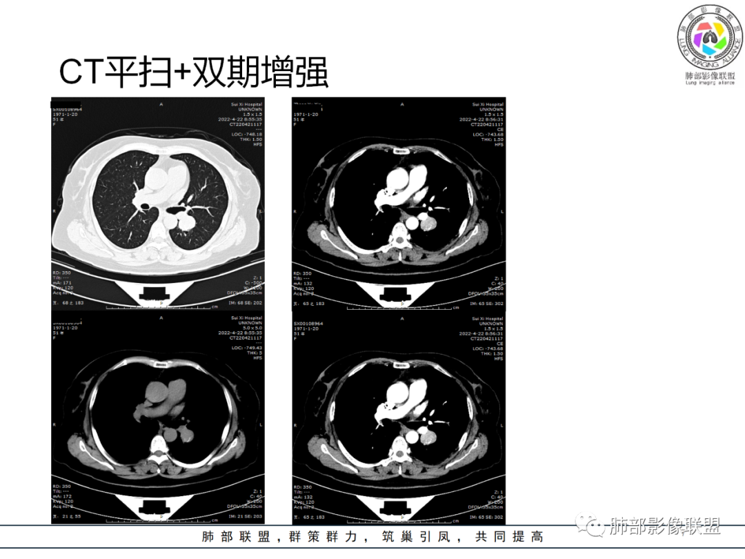 影像PPT - 【病例】硬化性肺泡细胞瘤PSP一例CT-7 影像PPT - 【病例】硬化性肺泡细胞瘤PSP一例CT-7