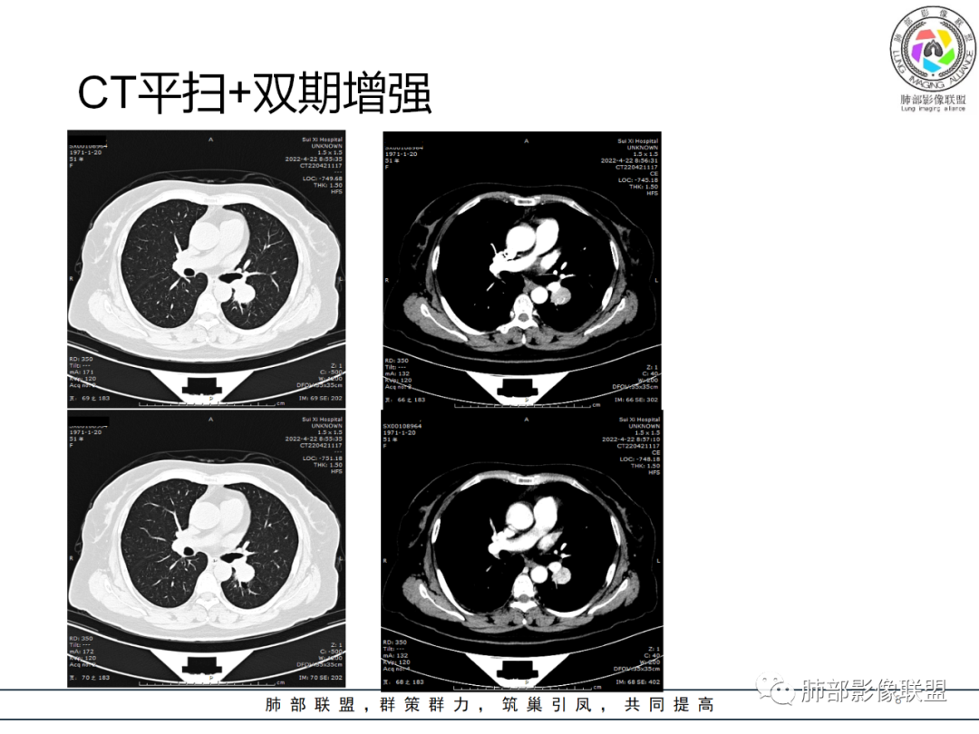 影像PPT - 【病例】硬化性肺泡细胞瘤PSP一例CT-8 影像PPT - 【病例】硬化性肺泡细胞瘤PSP一例CT-8