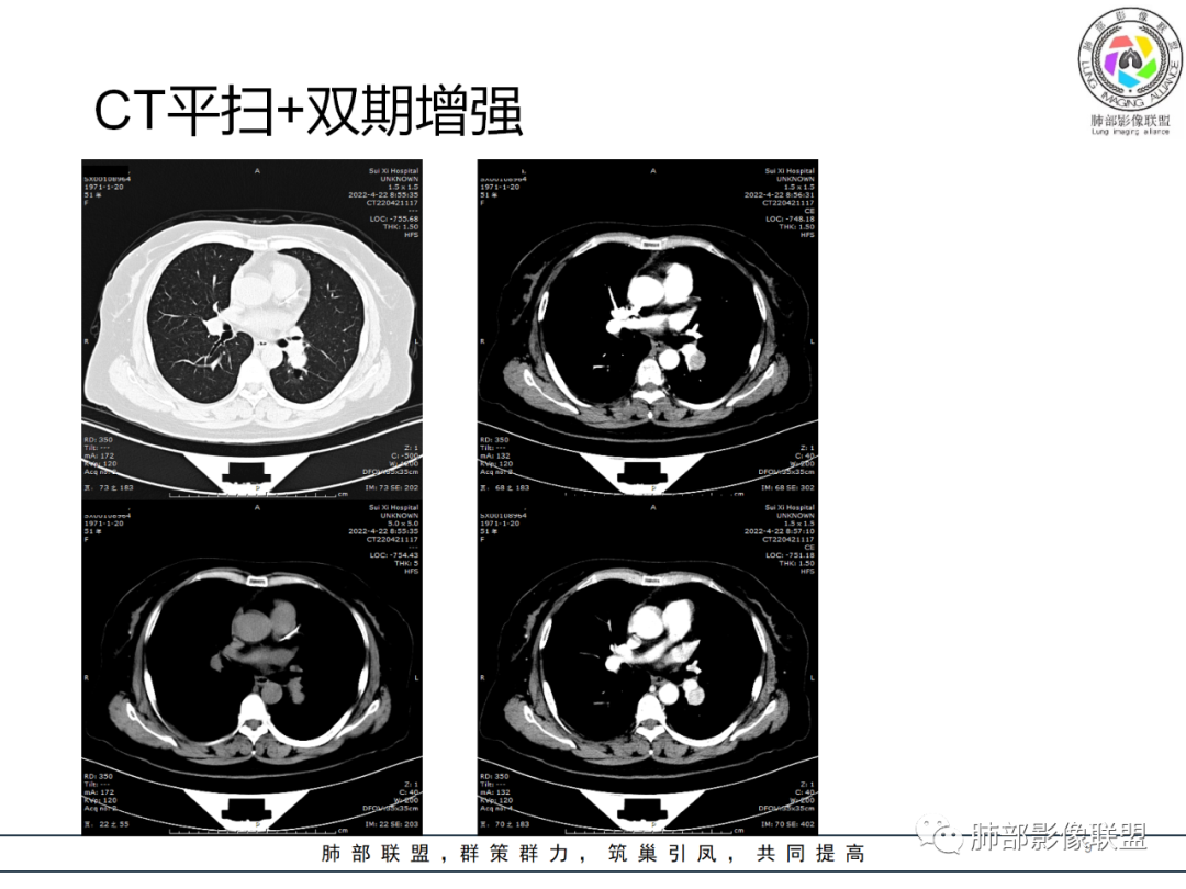 影像PPT - 【病例】硬化性肺泡细胞瘤PSP一例CT-9 影像PPT - 【病例】硬化性肺泡细胞瘤PSP一例CT-9