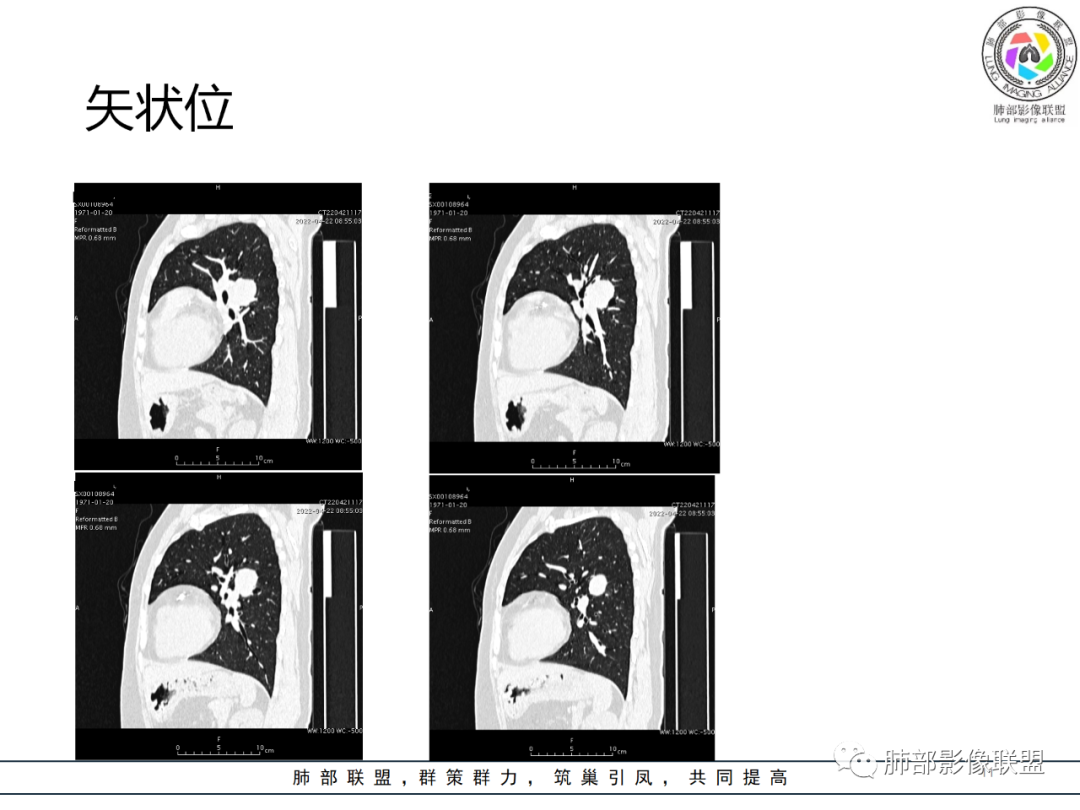 影像PPT - 【病例】硬化性肺泡细胞瘤PSP一例CT-11 影像PPT - 【病例】硬化性肺泡细胞瘤PSP一例CT-11