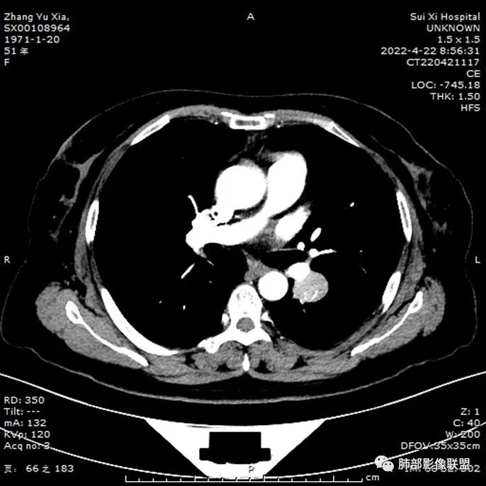 影像PPT - 【病例】硬化性肺泡细胞瘤PSP一例CT-13 影像PPT - 【病例】硬化性肺泡细胞瘤PSP一例CT-13
