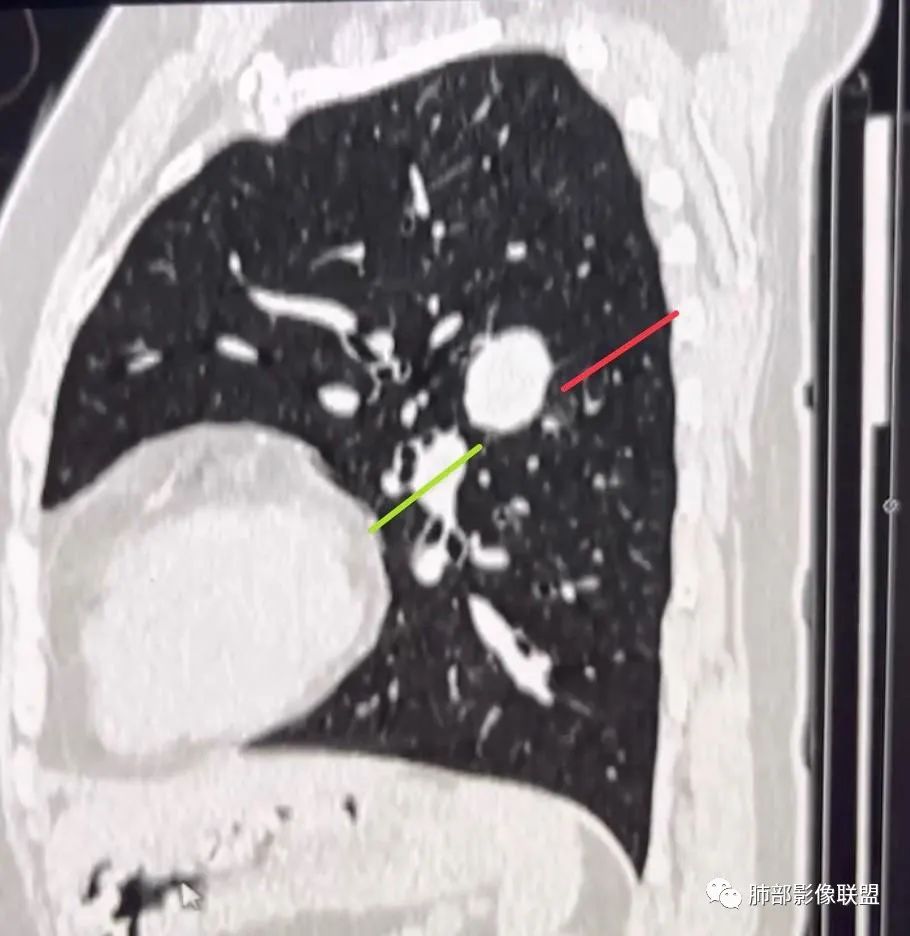 影像PPT - 【病例】硬化性肺泡细胞瘤PSP一例CT-14 影像PPT - 【病例】硬化性肺泡细胞瘤PSP一例CT-14