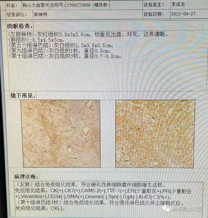 影像PPT - 【病例】硬化性肺泡细胞瘤PSP一例CT-15 影像PPT - 【病例】硬化性肺泡细胞瘤PSP一例CT-15