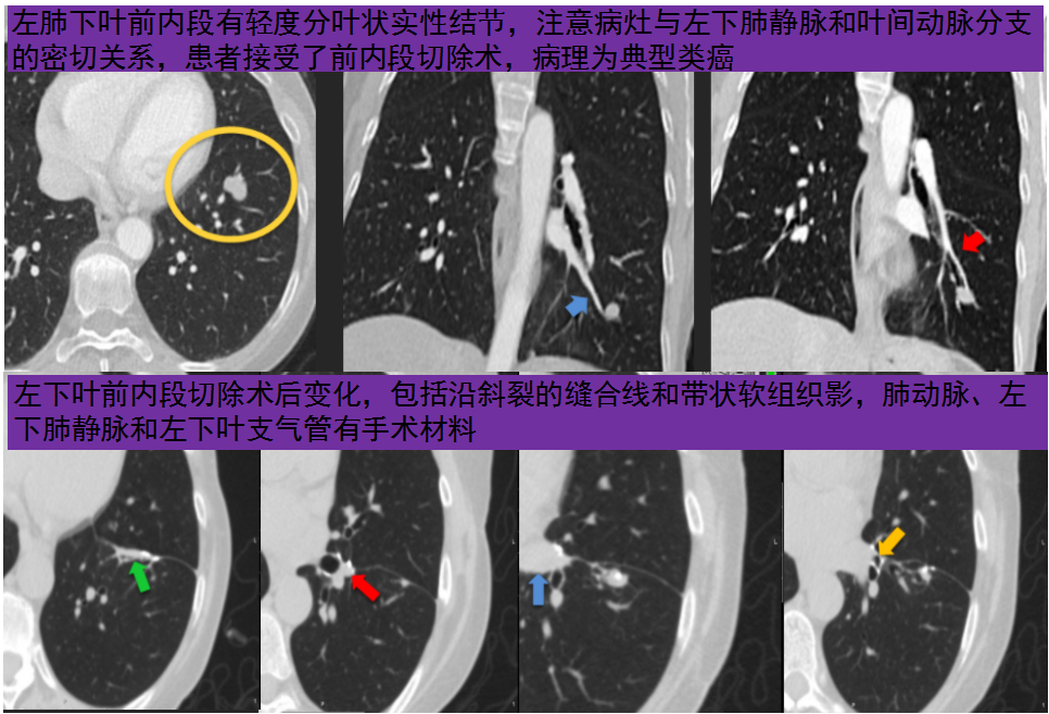 影像PPT - 肺部术后评估需要注意什么?-9 影像PPT - 肺部术后评估需要注意什么?-9