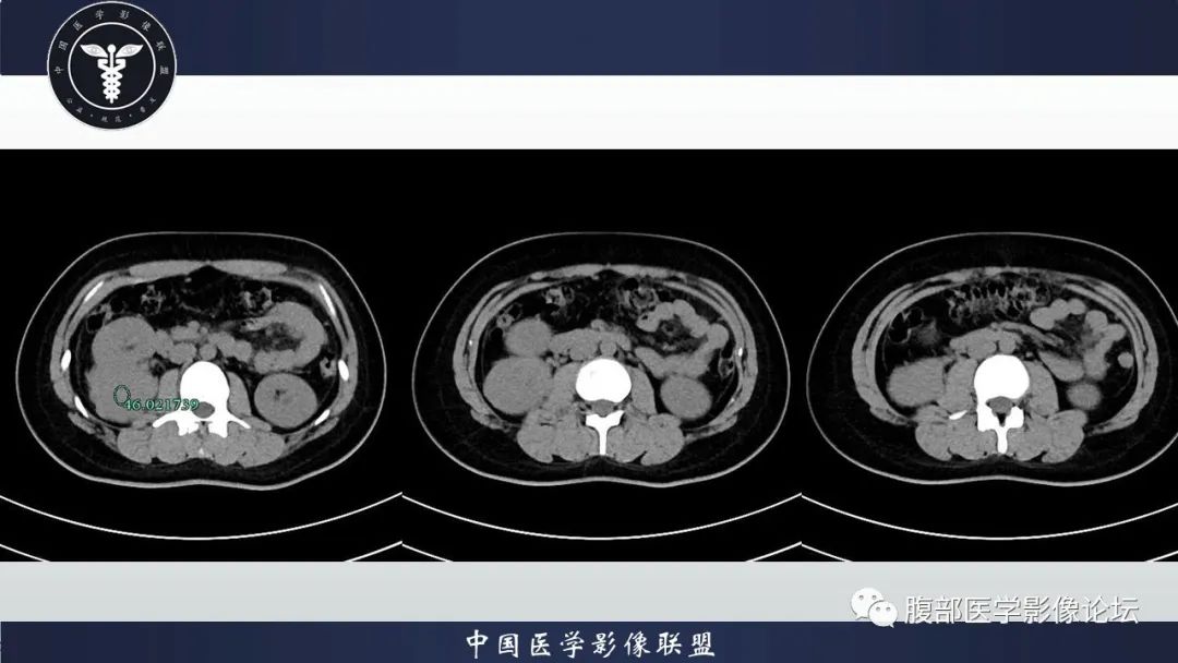 影像PPT - 【病例】肾脏血管平滑肌脂肪瘤1例CT影像-3