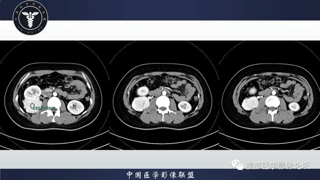 影像PPT - 【病例】肾脏血管平滑肌脂肪瘤1例CT影像-4