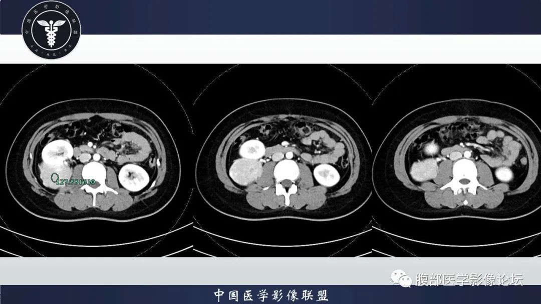影像PPT - 【病例】肾脏血管平滑肌脂肪瘤1例CT影像-5