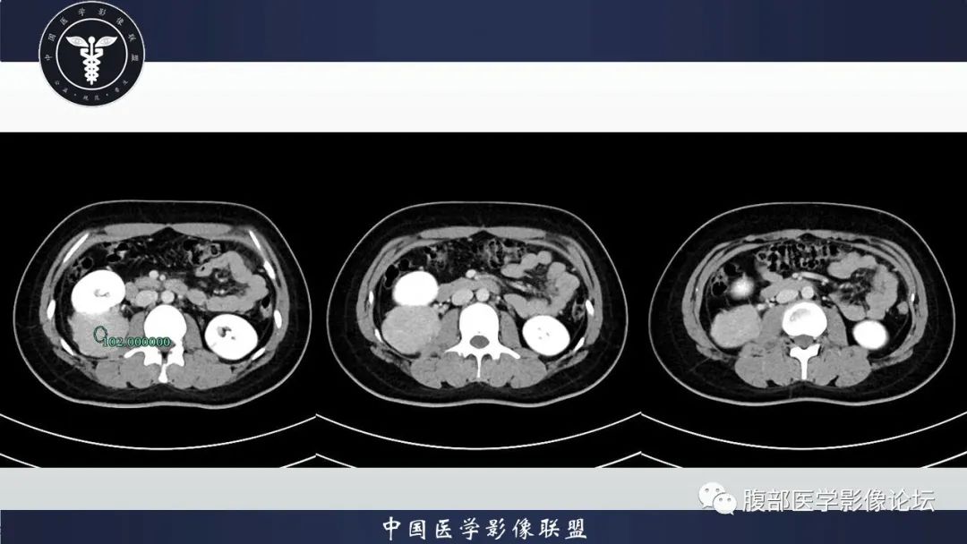 影像PPT - 【病例】肾脏血管平滑肌脂肪瘤1例CT影像-6