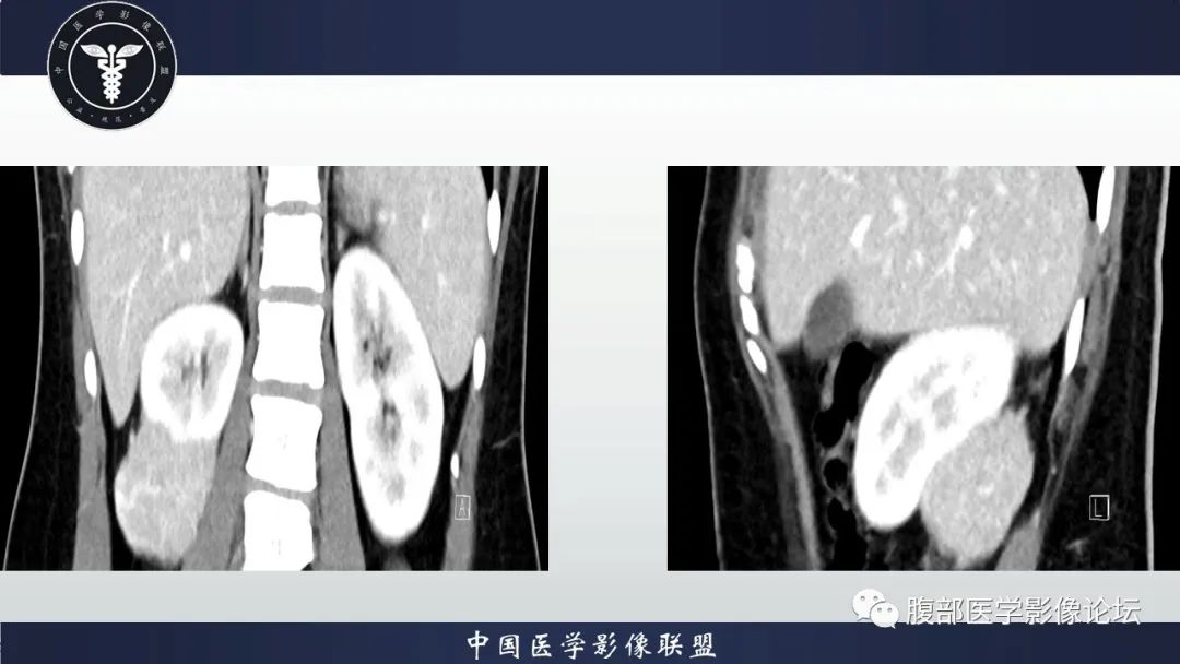 影像PPT - 【病例】肾脏血管平滑肌脂肪瘤1例CT影像-7