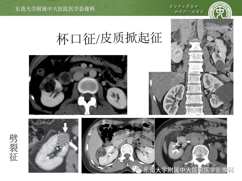 影像PPT - 【病例】肾脏血管平滑肌脂肪瘤1例CT影像-13