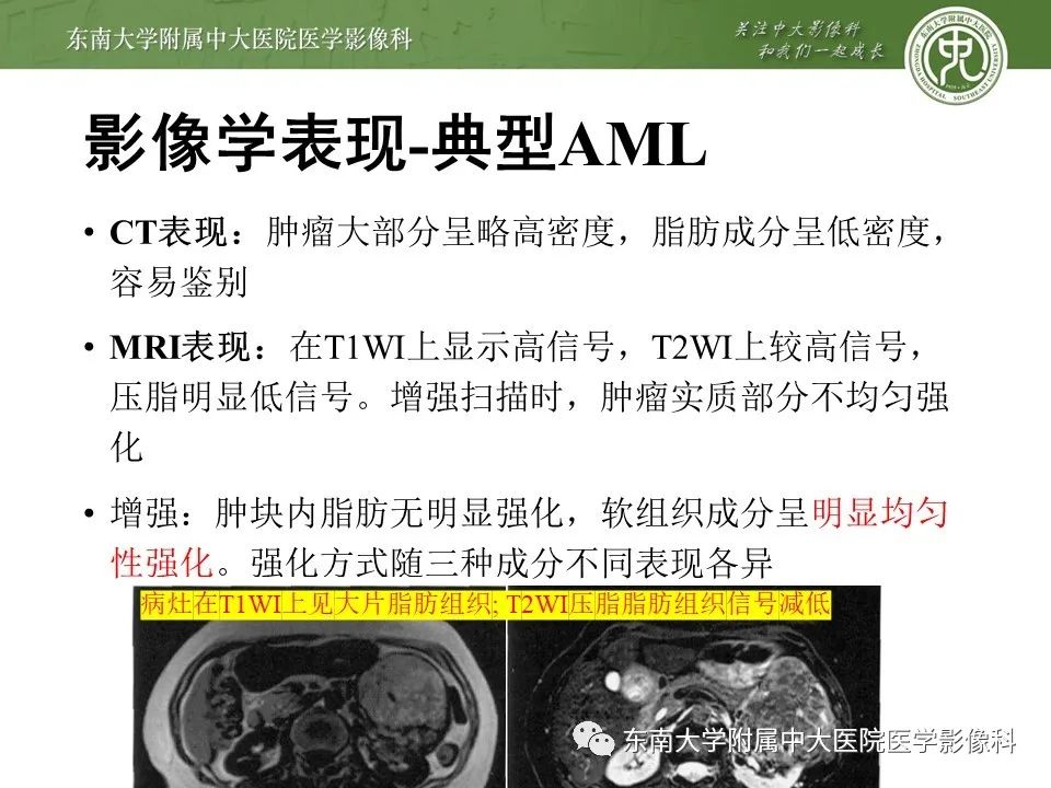 影像PPT - 【病例】肾脏血管平滑肌脂肪瘤1例CT影像-14