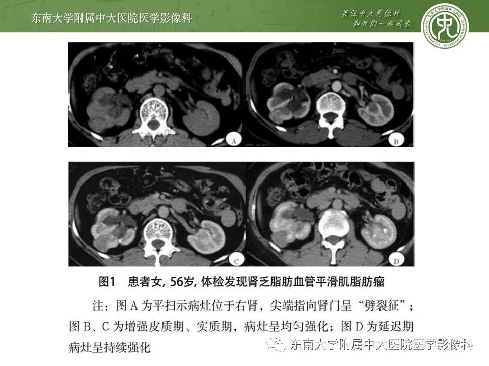 影像PPT - 【病例】肾脏血管平滑肌脂肪瘤1例CT影像-16