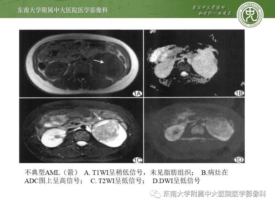 影像PPT - 【病例】肾脏血管平滑肌脂肪瘤1例CT影像-17