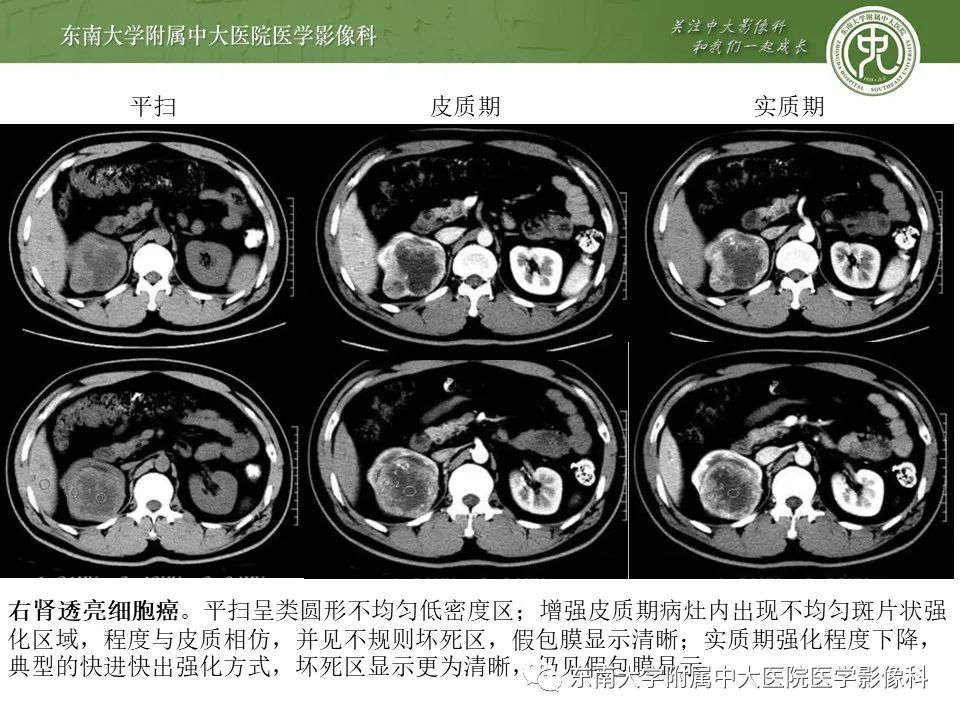 影像PPT - 【病例】肾脏血管平滑肌脂肪瘤1例CT影像-19
