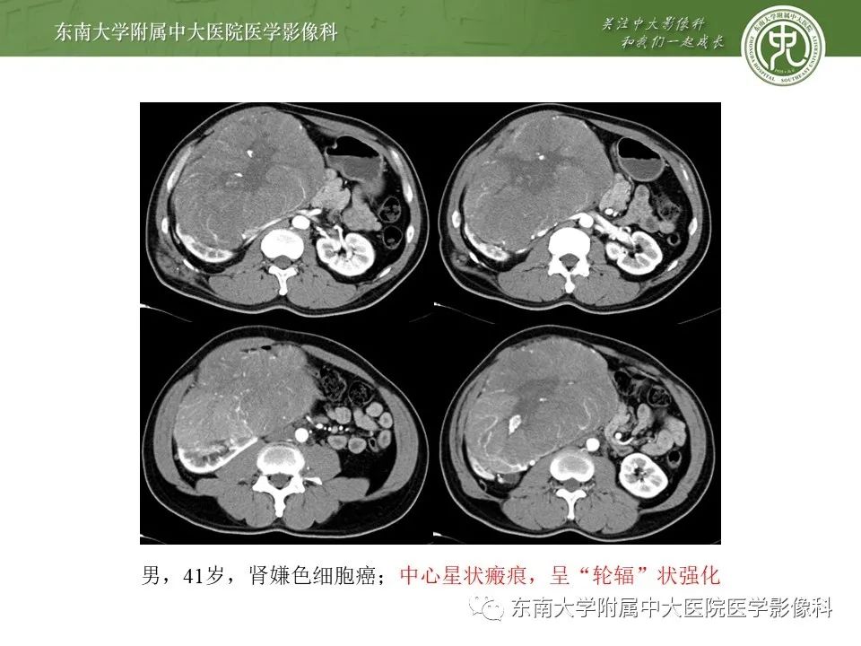 影像PPT - 【病例】肾脏血管平滑肌脂肪瘤1例CT影像-21