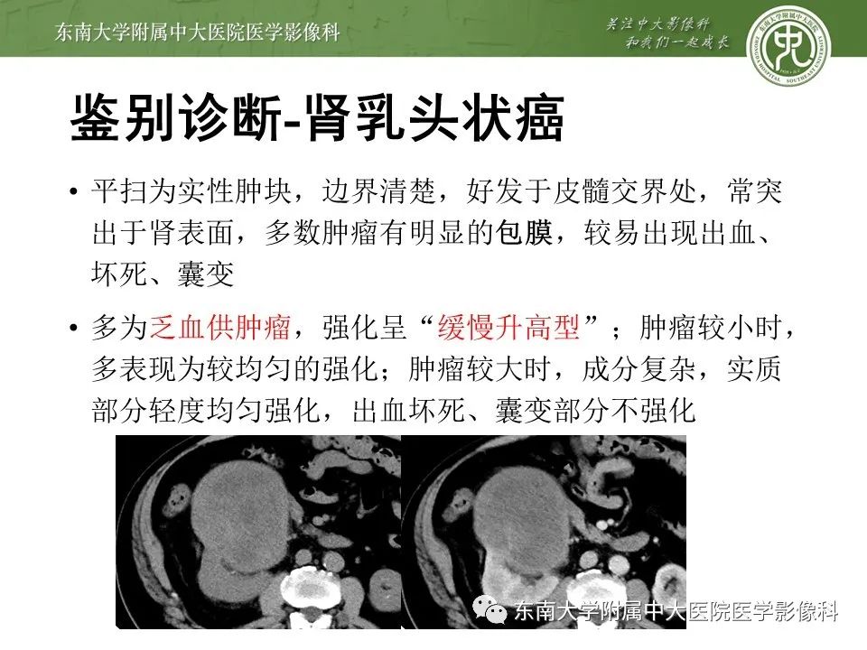 影像PPT - 【病例】肾脏血管平滑肌脂肪瘤1例CT影像-22