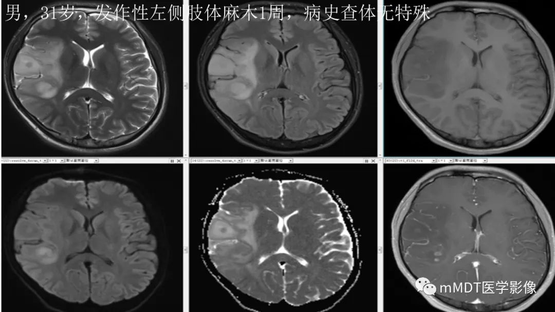 影像PPT - 【PPT】星形细胞瘤的新认识-2