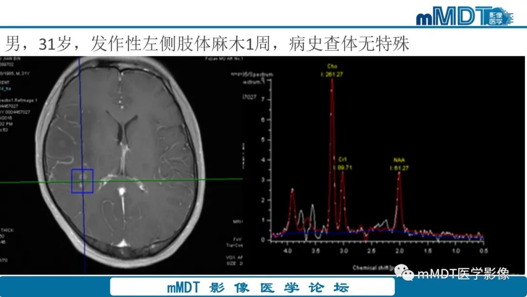 影像PPT - 【PPT】星形细胞瘤的新认识-3