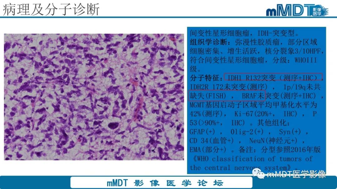 影像PPT - 【PPT】星形细胞瘤的新认识-8