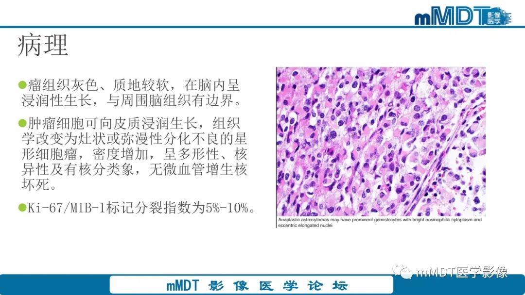 影像PPT - 【PPT】星形细胞瘤的新认识-19