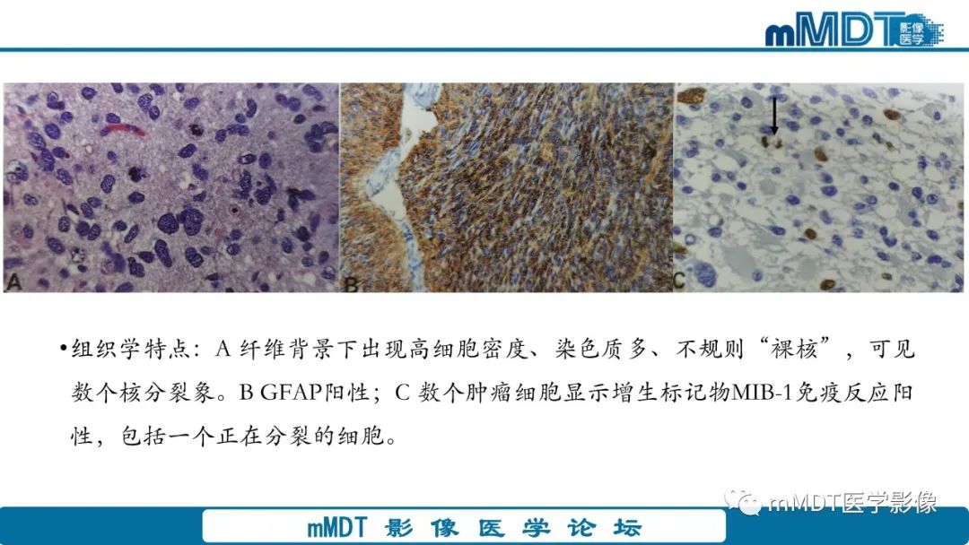 影像PPT - 【PPT】星形细胞瘤的新认识-20